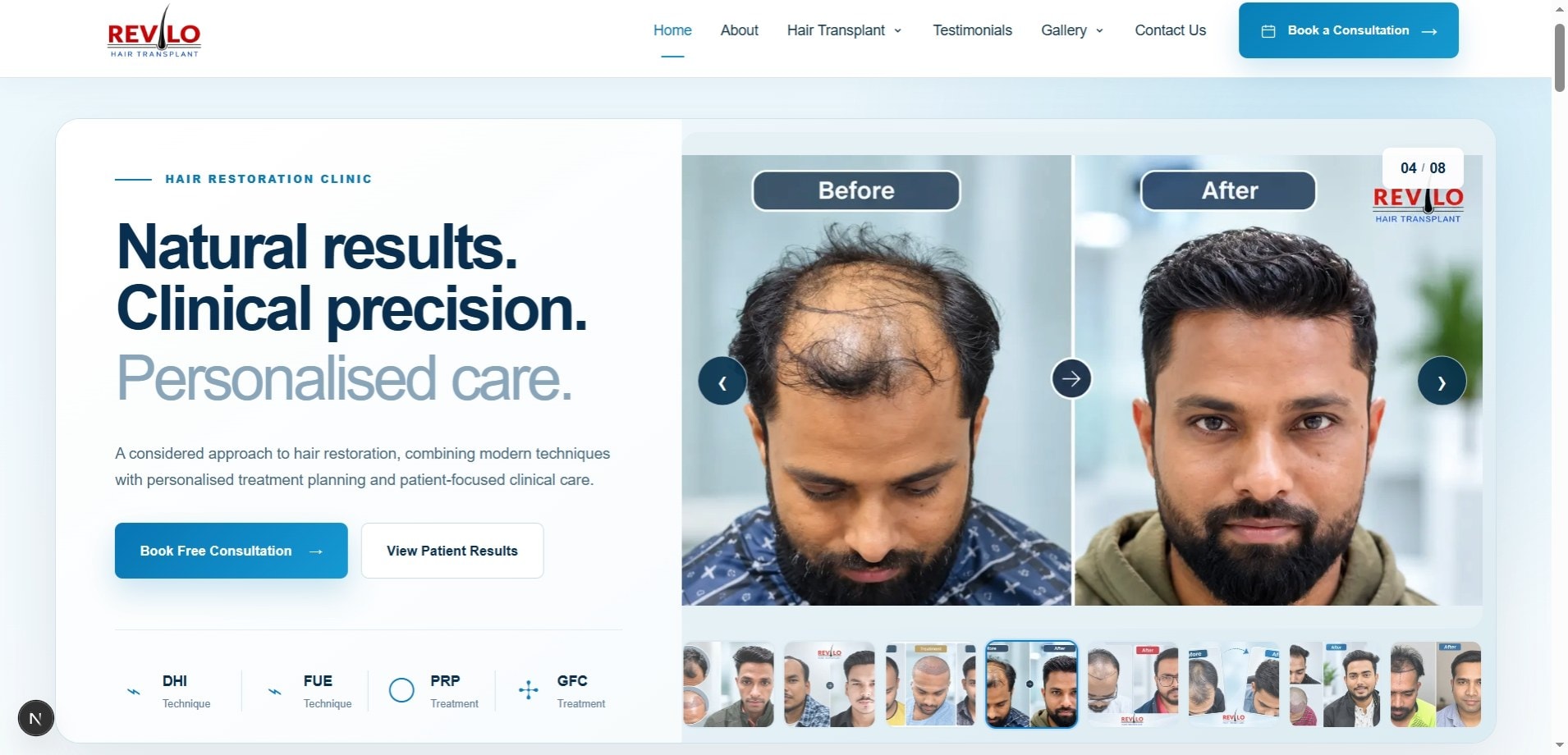 Screenshot of the Revilo Hair Transplant website showing its navigation, hair restoration introduction and before-and-after gallery